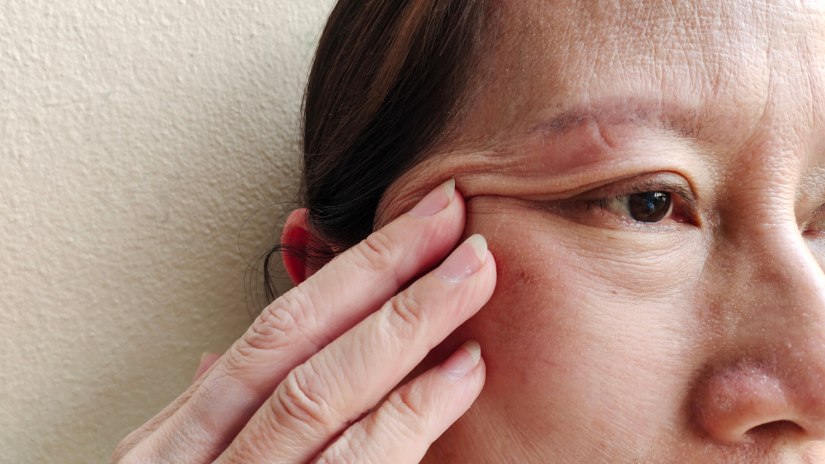 radiofrequency-assisted lipolysis